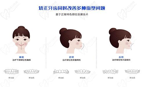 正雅医生矫正案例对比配图